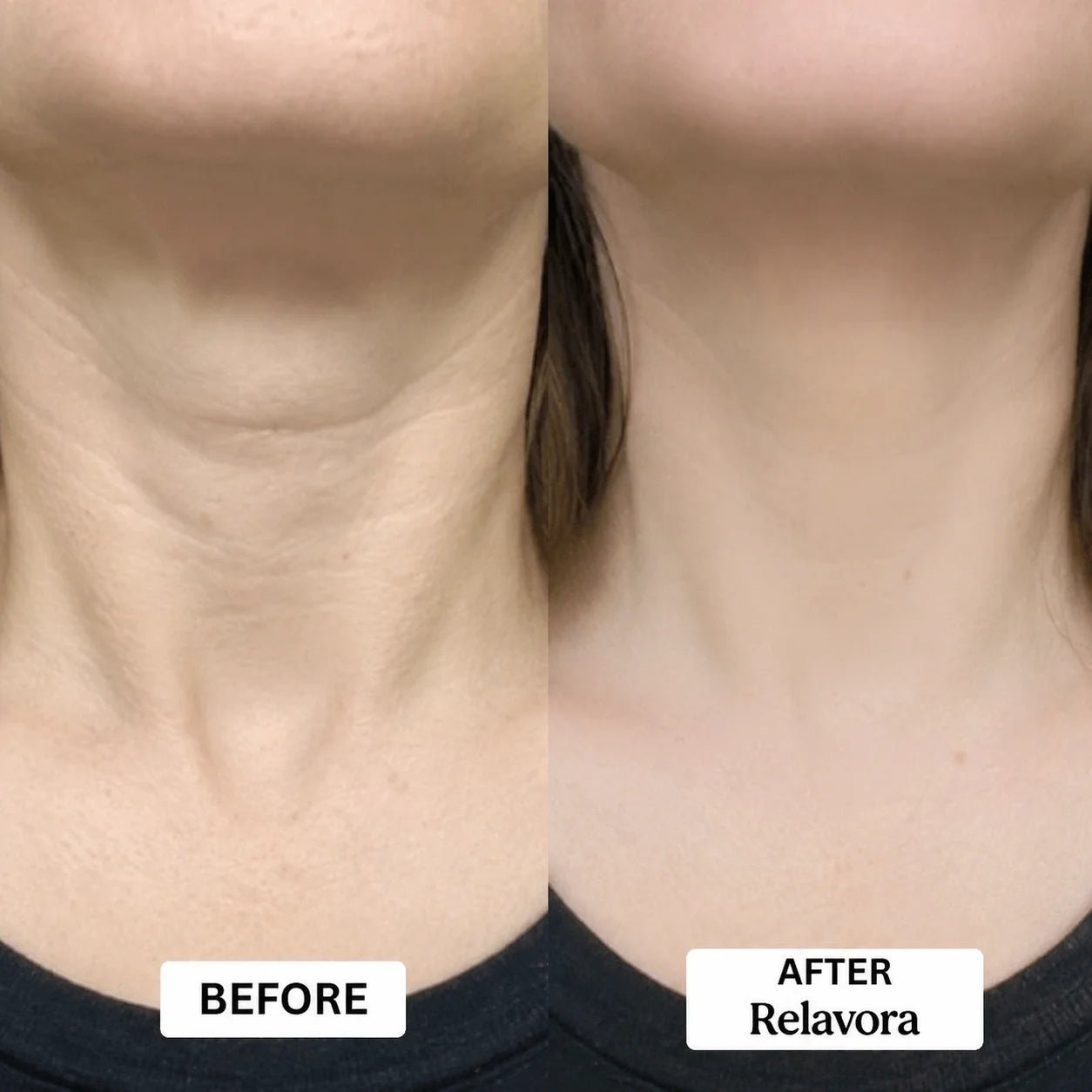 Relavora™ Micro Infusion System - Relavora