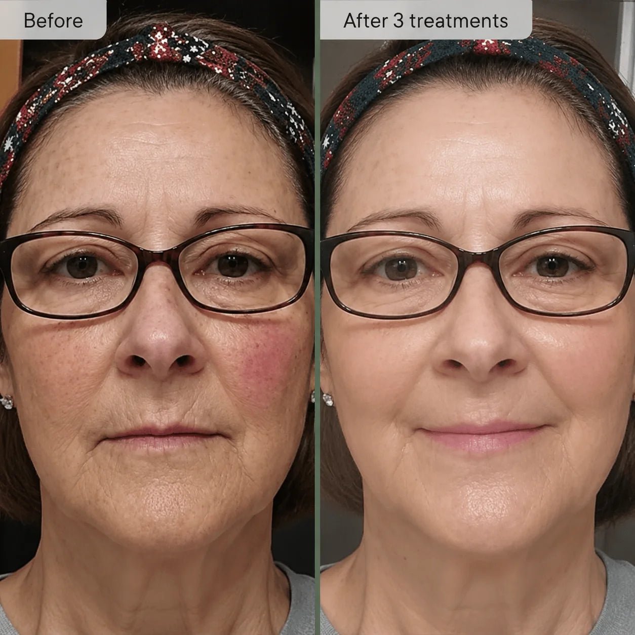 Relavora™ Micro Infusion System - Relavora