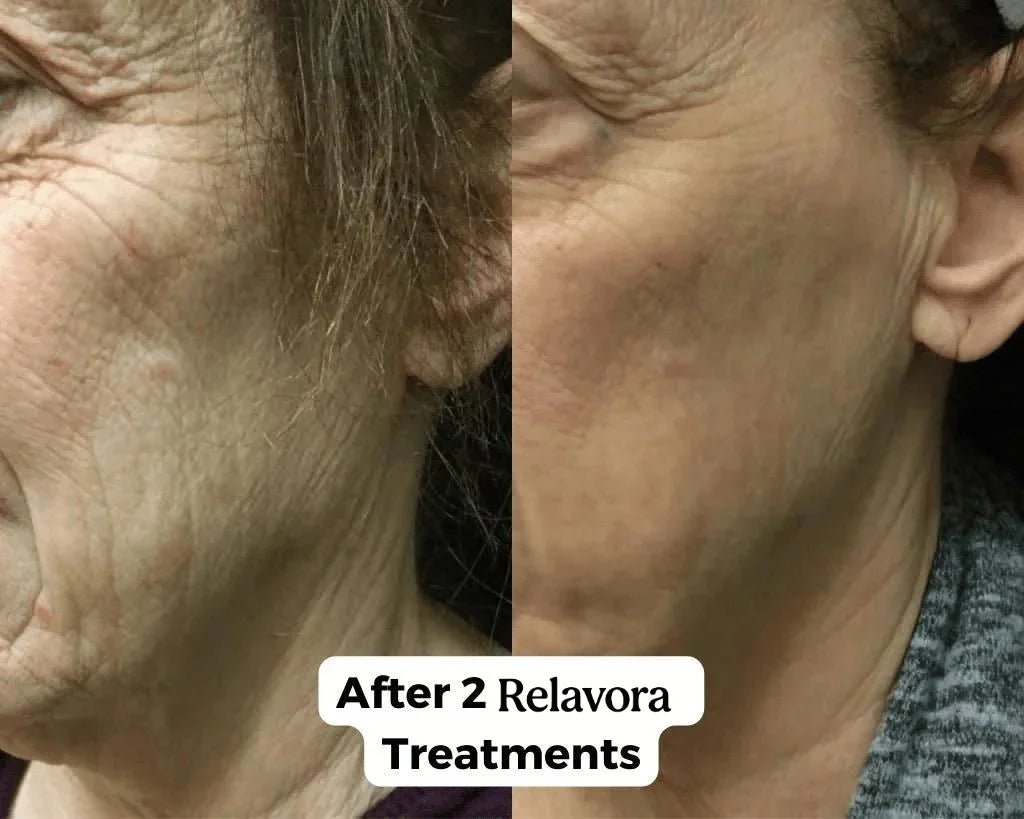 Relavora™ Micro Infusion System - Relavora