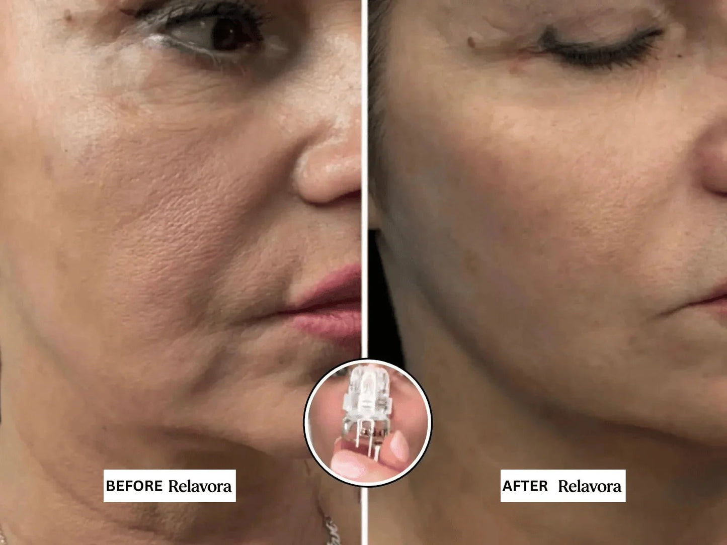 Relavora™ Micro Infusion System - Relavora