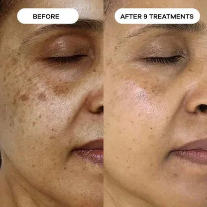 Relavora™ Micro Infusion System - Relavora