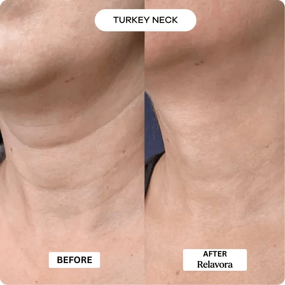 Relavora™ Micro Infusion System - Relavora