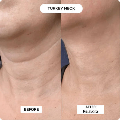 Relavora™ Micro Infusion System - Relavora