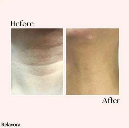 Relavora™ Micro Infusion System - Relavora
