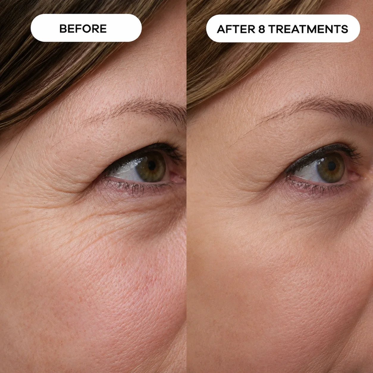 Relavora™ Micro Infusion System - Relavora