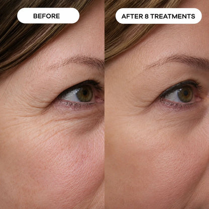 Relavora™ Micro Infusion System - Relavora