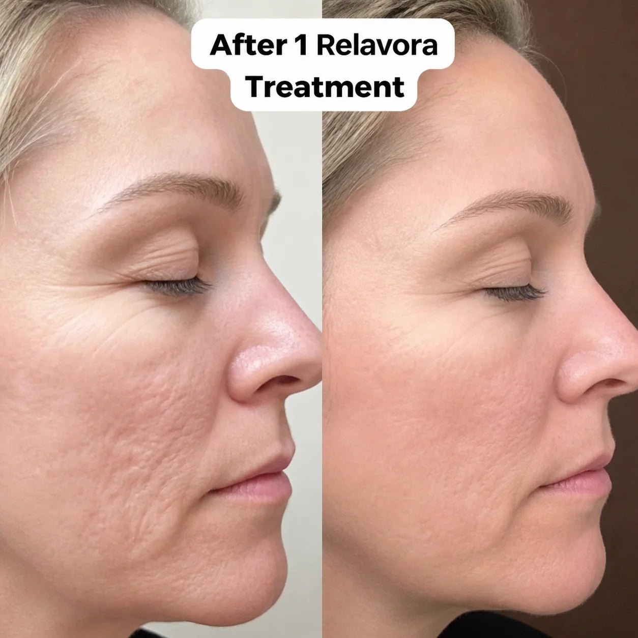 Relavora™ Micro Infusion System - Relavora