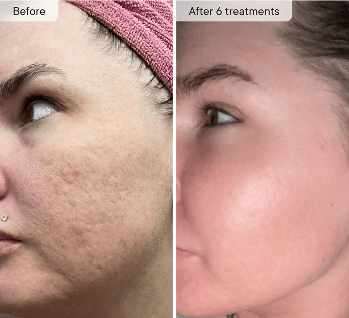 Relavora™ Micro Infusion System - Relavora