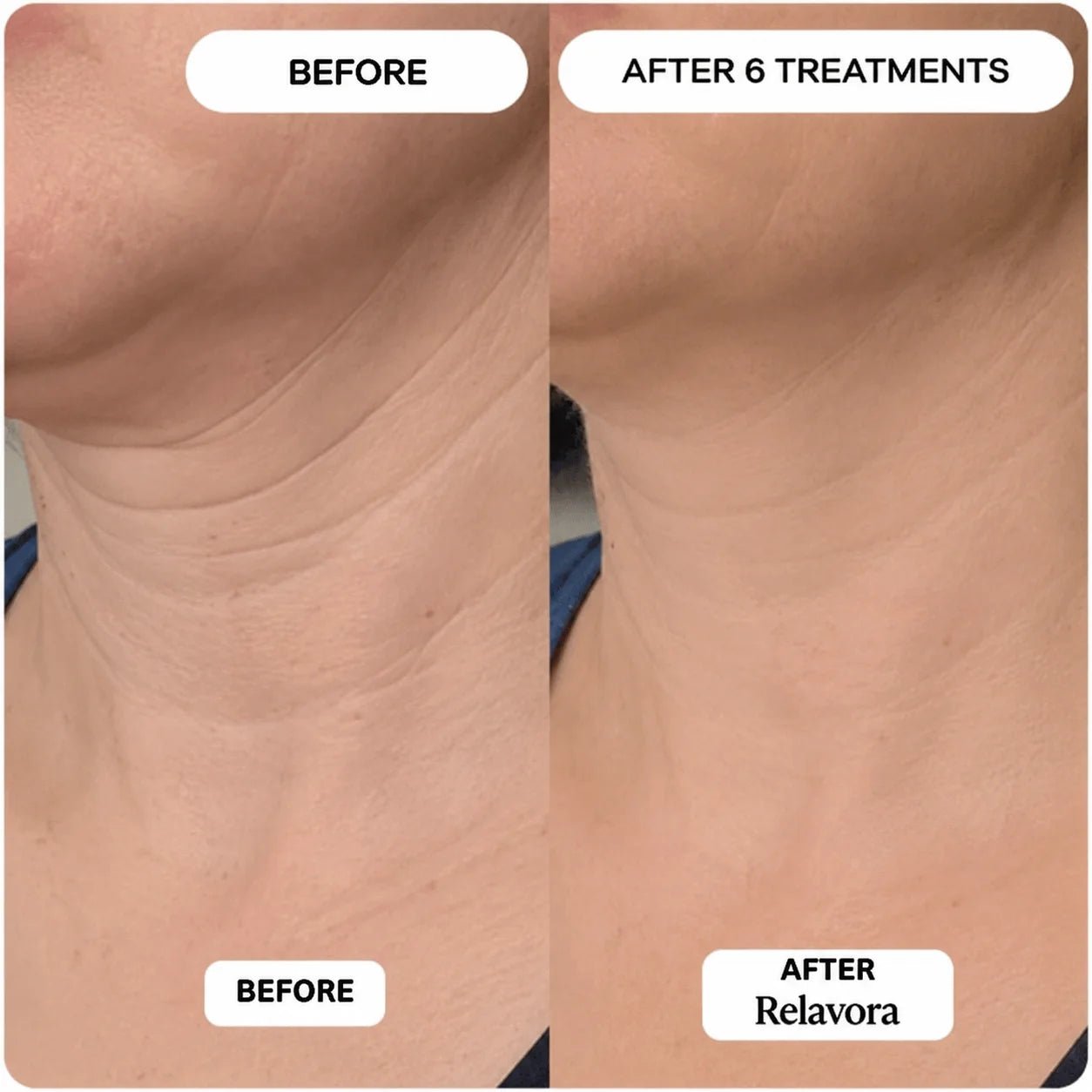 Relavora™ Micro Infusion System - Relavora