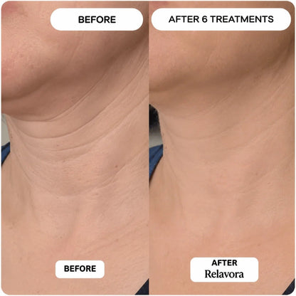 Relavora™ Micro Infusion System - Relavora