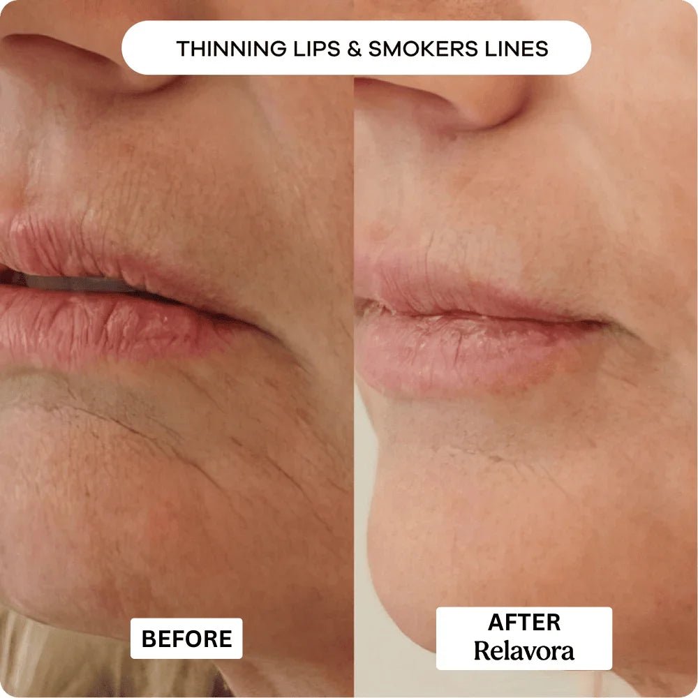 Relavora™ Micro Infusion System - Relavora