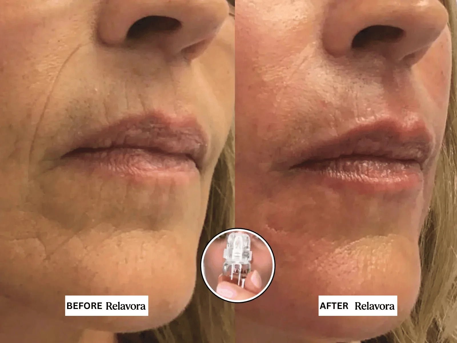 Relavora™ Micro Infusion System - Relavora