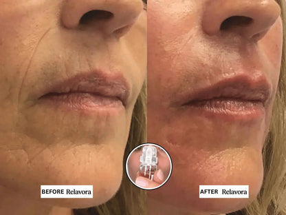 Relavora™ Micro Infusion System - Relavora