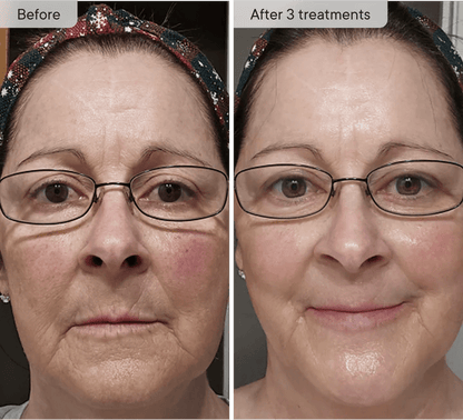 Relavora™ Micro Infusion System - Relavora