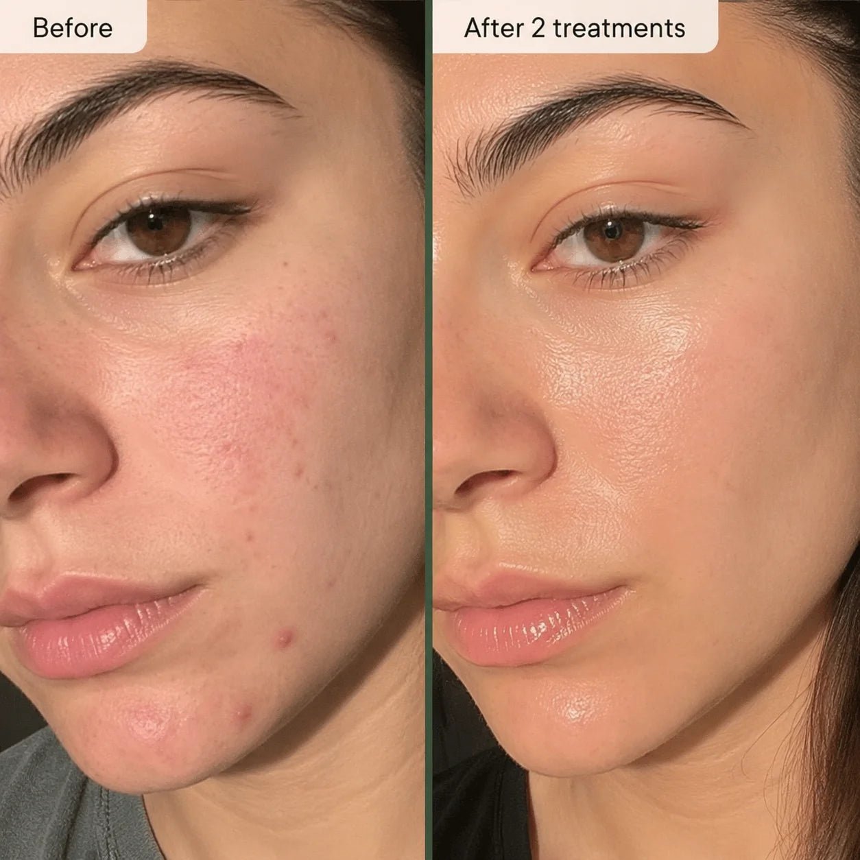 Relavora™ Micro Infusion System - Relavora