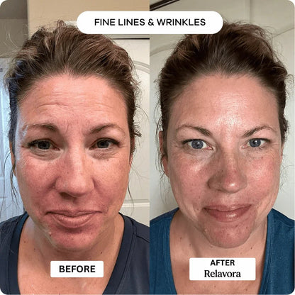 Relavora™ Micro Infusion System - Relavora