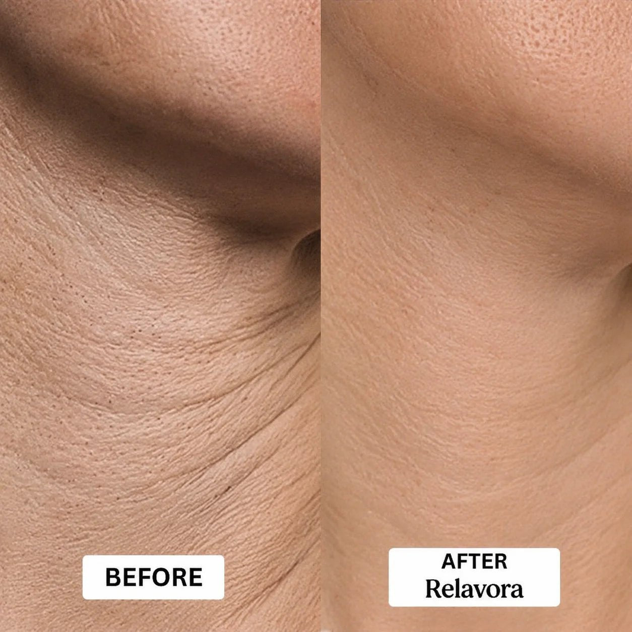 Relavora™ Micro Infusion System - Relavora