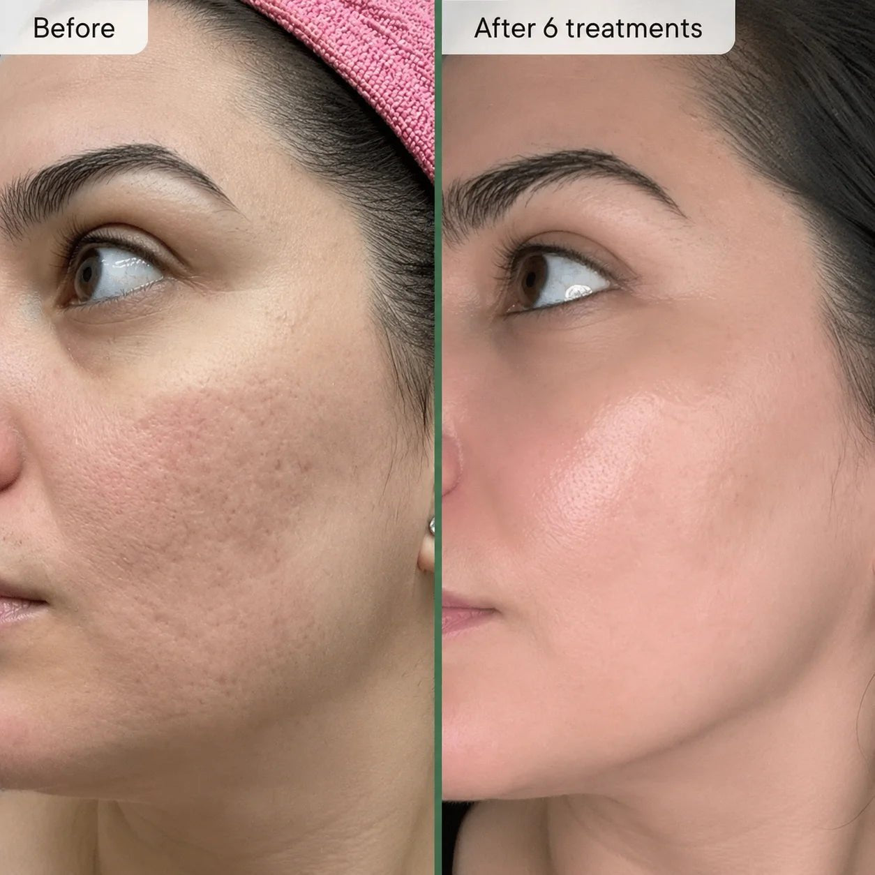 Relavora™ Micro Infusion System - Relavora
