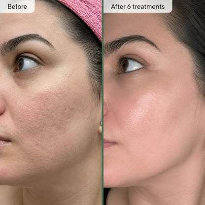 Relavora™ Micro Infusion System - Relavora