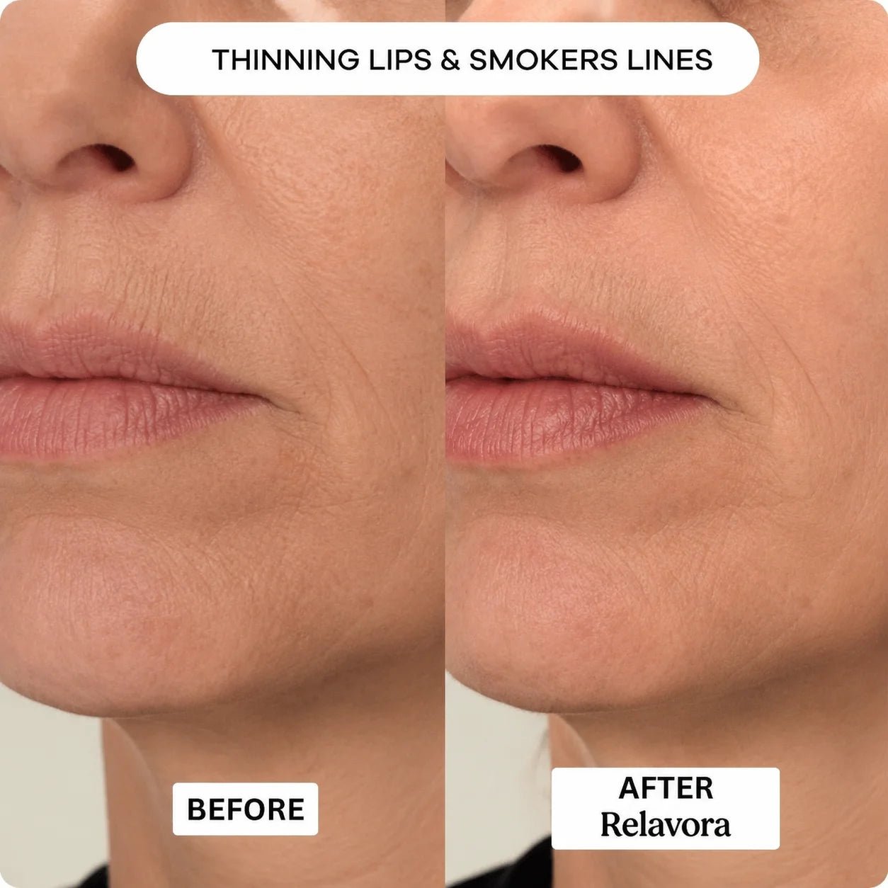 Relavora™ Micro Infusion System - Relavora