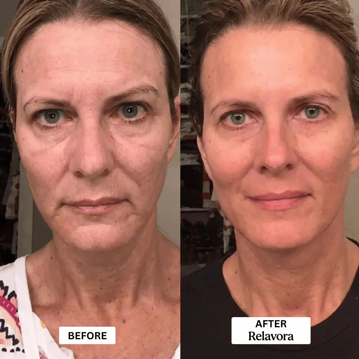 Relavora™ Micro Infusion System - Relavora