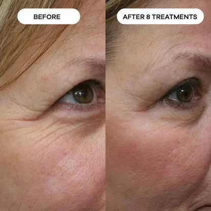 Relavora™ Micro Infusion System - Relavora