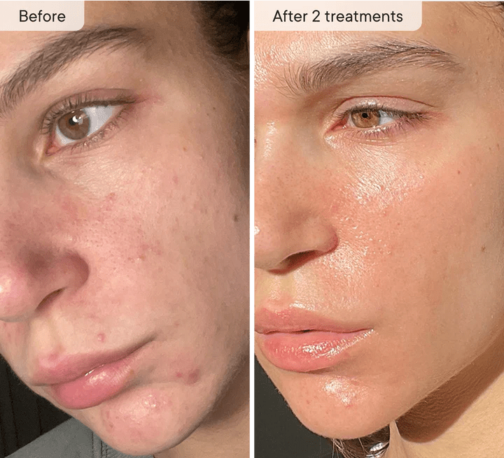 Relavora™ Micro Infusion System - Relavora