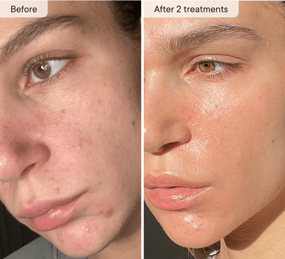 Relavora™ Micro Infusion System - Relavora