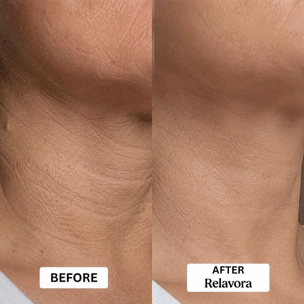 Relavora™ Micro Infusion System - Relavora
